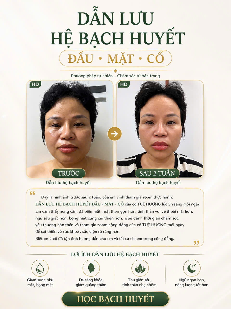 Học viên dẫn lưu đầu - mặt - cổ - kết quả sau dẫn lưu hệ bạch huyết