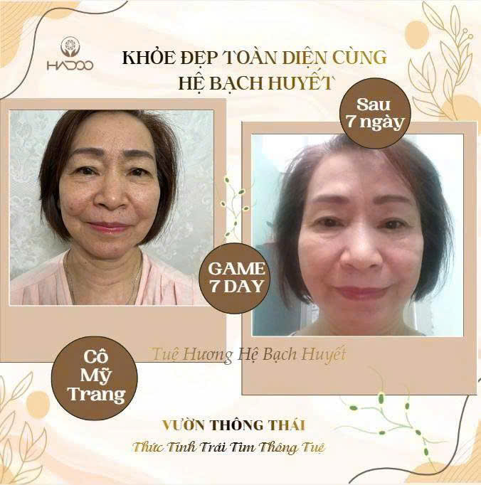 Cô Mỹ Trang - kết quả Game 7 Day dẫn lưu bạch huyết, da căng và tươi trẻ hơn sau 7 ngày
