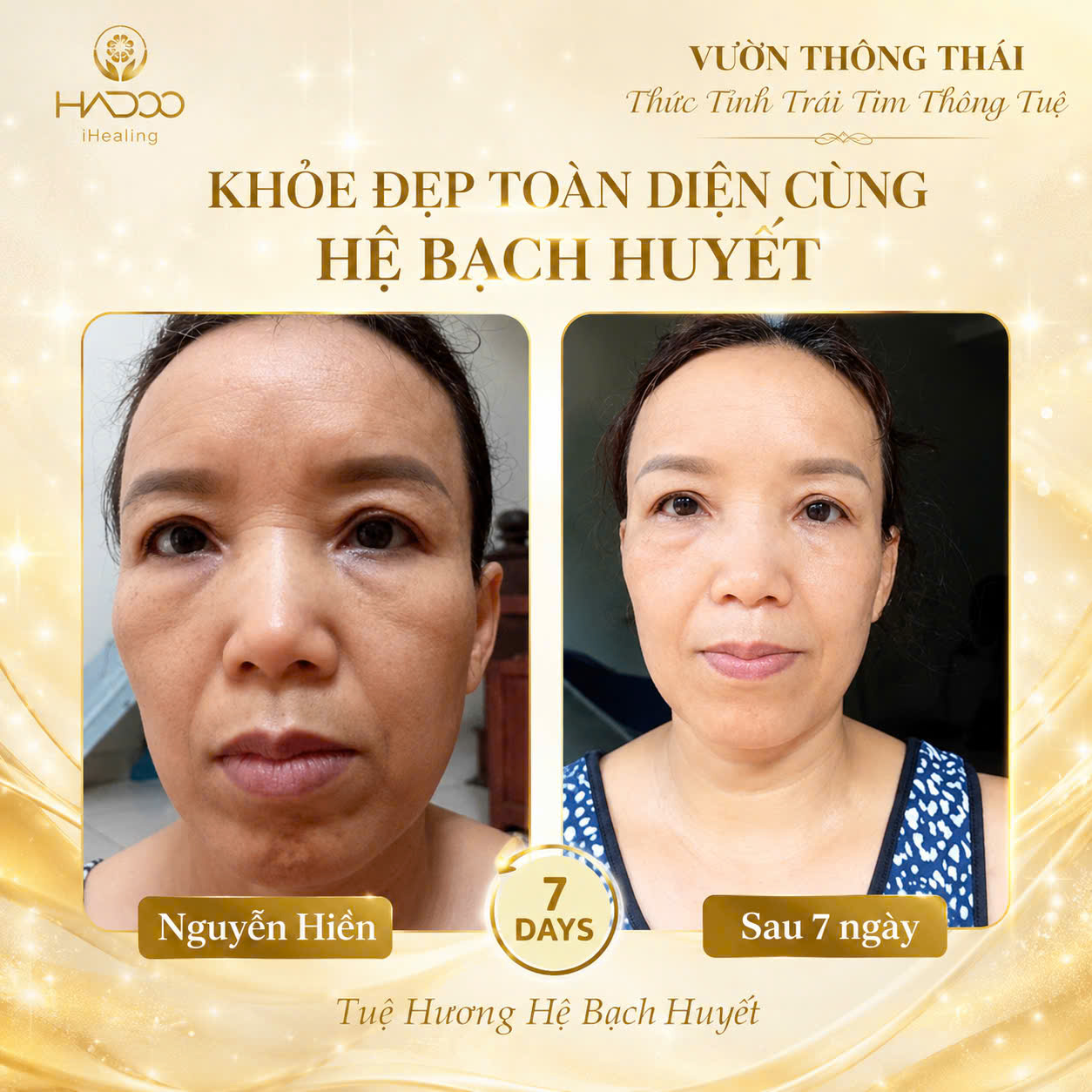 Nguyễn Hiền - kết quả Before/After sau 7 ngày dẫn lưu bạch huyết đầu mặt cổ